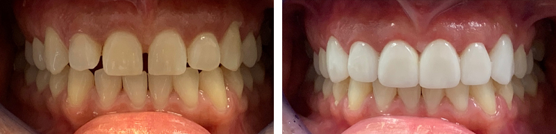 Veneers Before & After Results - 1