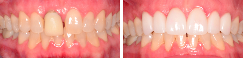 Veneers Before & After Results - 3