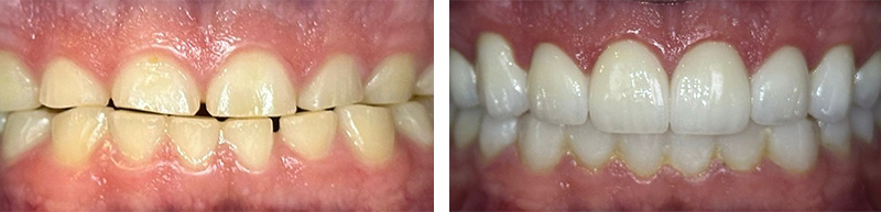 Before after image of Full Mouth Rehabilitation at El Paso Modern Dentistry