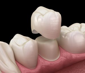Dental crown premolar tooth assembly process