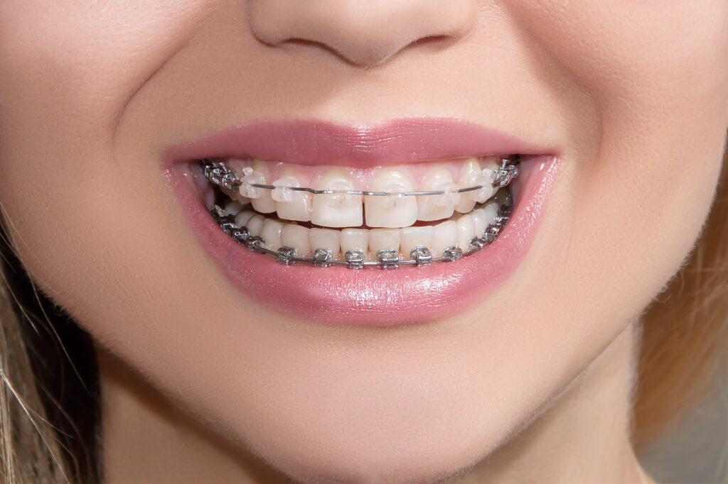Orthodontics El Paso